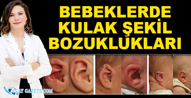 BEBEKLERDE KULAK ŞEKİL BOZUKLUKLARI TEDAVİSİ NASIL YAPILIR?